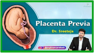 Placenta Previa Etiology Pathophysiology Clinical presentation Diagnosis and Treatment [upl. by Grosberg]