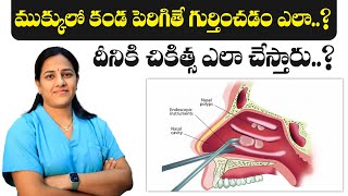 How to Treat Nasal Polyps  Diagnosis and Treatment of Nasal Polyps  Dr Harika ENT Care Hospital [upl. by Tema]