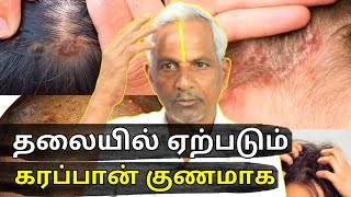 தலையில் வரக்கூடிய கரப்பான்  Scalp eczema treatment  Mandai karappan  Thanithuvamm [upl. by Eerak623]