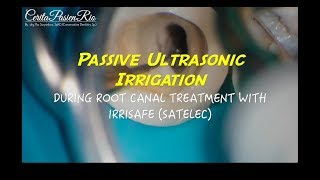 passive ultrasonic irrigation with irrisafe satelec in endodontic treatment [upl. by Saalocin]