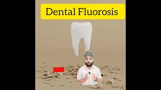 Dental Fluorosisक्या हैFluoride teeth treatmentytytshorts shorts dentalclinicdentist in Patna [upl. by Naraa]