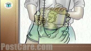 Discharge Emptying a Urinary Drainage Bag MiniFree Patient Education Medical Video [upl. by Winne]