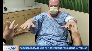 Focused Ultrasound as a treatment for Essential tremor [upl. by Per905]