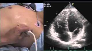 Intro to Echo Apical 4 Chamber Viewmov [upl. by Nnil]