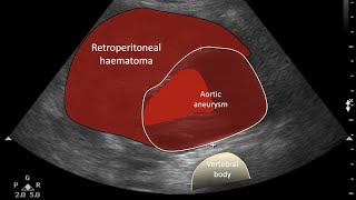 Abdominal Aortic Aneurysm Ultrasound [upl. by Clarisa]