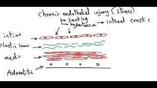 Systemic pathology 10  CVS  atherosclerosis  DRSAMEH GHAZY [upl. by Annekim]