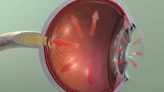 Animation Glaucoma [upl. by Nedak]