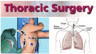 Thoracic Surgery 3  Thoracic Trauma  Open Pneumothorax HemothoraxFlail Chest  UQs [upl. by Enitsua352]