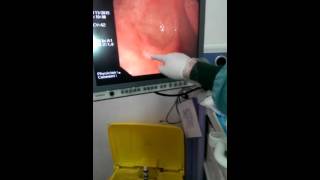 How to perform upper GI endoscopy [upl. by Sirap]