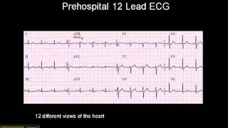 1215 Lead ECG The 12 Leads [upl. by Joelle]