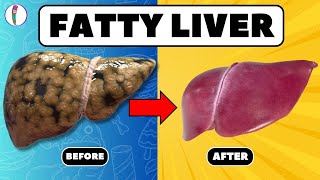 Strictly Avoid these 5 Foods if you have Fatty Liver  Fatty liver treatment  liver disease [upl. by Bortman369]