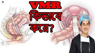 Simplified video of VMR for rectal prolapse [upl. by Enitsej]