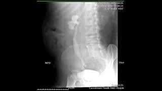 CASE REVIEW intravenous pyelography IVP [upl. by Mikaela73]