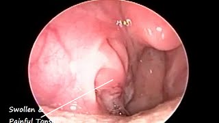 Endoscopy of Throat amp Nose in a case of Intratonsillar Abscess [upl. by Edahsalof]