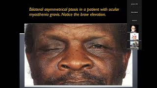 Approach to patient with diplopia [upl. by Atinoj]