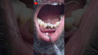 Extraction of Decayed Front Aesthetic Teeth toothextraction rootcanaltreatment dentistry [upl. by Akcired]