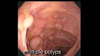 Colonoscopy FollowUp of Colon Polyp  Los Angeles Colonoscopy [upl. by Ytsihc]