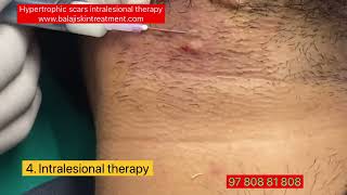 Hypertrophic scar treatment by intralesional therapy Dr Sandeep Gupta BALAJI SKIN CLINIC Hari Nagar [upl. by Nairred]