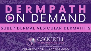 Subepidermal Vesicular Dermatitis [upl. by Enelez725]