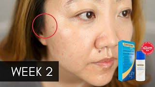 Acne Skincare  Week 2 on Differin Adapalene Treatment  Oily Skin [upl. by Analli923]