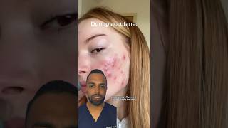 How does ACCUTANE work Dr Somji Explains [upl. by Jasisa]