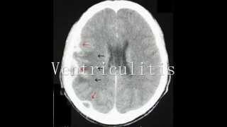 Intracranial Empyema and Ventriculitis Radiologic Features [upl. by Talich]