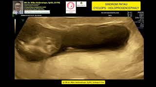 Sindrom Patau Holoprosencephaly  Cyclops 13 weeks [upl. by Rakia]