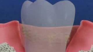 Periodontal Disease amp Treatment [upl. by Carola]