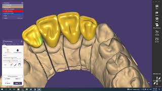 Exocad How to design cutback Crown [upl. by Mcginnis151]