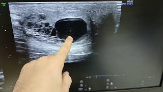 Ultrasound  Testicular Cysts  Hydrocele [upl. by Stefania]