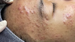 ACNE TREATMENT VU QUYNH MI  Perennial Blackheads On Boy Face 2024FULL [upl. by Zehc506]