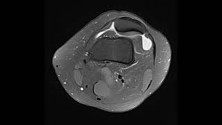 Trochlear dysplasia [upl. by Netsrik]