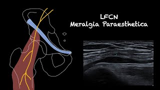 Ultrasound of the Lateral Femoral Cutaneous NerveMeralgia Paraesthetica [upl. by Fraase949]