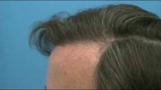 Best Hair Transplants  Dr Wong  4000 Grafts  1 Session [upl. by Yrojram]