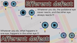 Pupil 2  Characteristics of Afferent and Efferent Pupillary Defects [upl. by Maon]