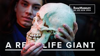 WE HAVE A GIANT Exploring the Rare Condition of Gigantism  The Bone Museum [upl. by Hnahc]