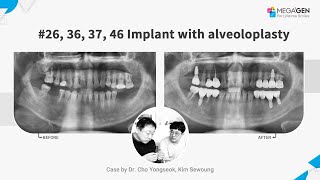 Dr Yongseok CHO Sewoung KIM 26363746 implant with alveoloplasty [upl. by Samau]