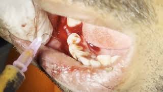 Explosive Dental abscess drainage and tooth extraction  Live On Patient [upl. by Menell]