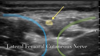 Ultrasonology of the Lateral Femoral Cutaneous Nerve [upl. by Lochner]