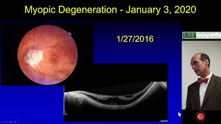 Myopic Degeneration  Ophthalmology Resident Lecture [upl. by Downs]