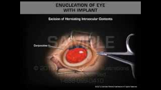 Enucleation of Eye with Implant [upl. by Ylurt]