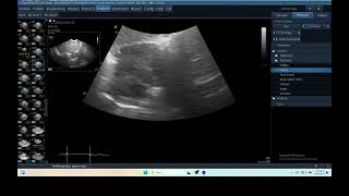 IQ 293 LUNG TUMOUR TFAST ULTRASOUND ECHOPAC ANALYSIS 3 [upl. by Kristel]