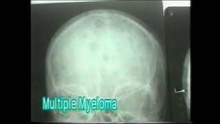 1221 Skull in Multiple Myeloma  Xray Reading  Dr Vaidya [upl. by Aihseym190]