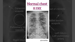 Normal chest xray  shortsvideo xray normalxray [upl. by Lenore]