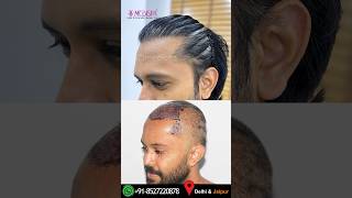 The Best Hair Transplant Results in India by Dr Suneet Soni at Medispa Hair Transplant Centre [upl. by Adiaroz]