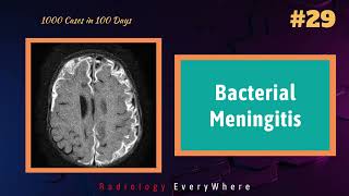 Bacterial Meningitis Radiology Video  1000 cases in 100 days  Video 29  CNS infections [upl. by Aihsilat151]