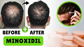 This is How I Restored my Hair loss In 3 Months [upl. by Annoled]