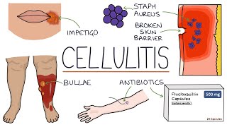 Understanding Cellulitis Skin and Soft Tissue Infections [upl. by Sadie]