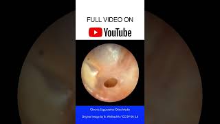 Chronic Suppurative Otitis Media Otoscopy [upl. by Mathias204]