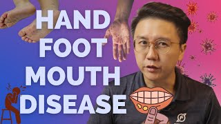 Hand Foot Mouth Disease HFMD  Symptoms and Treatments [upl. by Robinia]